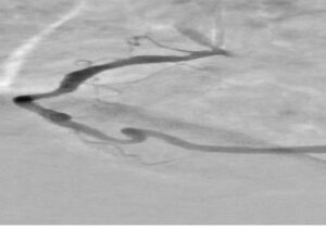 امکان افزایش دقت نمایش عروق کرونری قلب با روش‌های مبتنی بر هوش مصنوعی