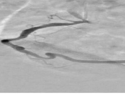 امکان افزایش دقت نمایش عروق کرونری قلب با روش‌های مبتنی بر هوش مصنوعی