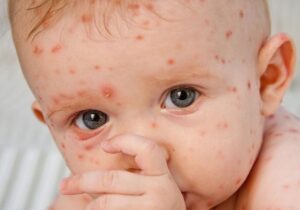 شیوع «آبله مرغان» در بهار