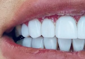 نگرانیهای دندانپزشکی در بارداری