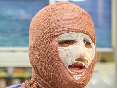 «جان نو» به کمک بیماران سوختگی میآید