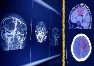 راهکار پژوهشگران دانشگاه تهران برای امنیت هوش مصنوعی در MRI مغز
