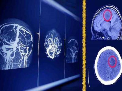 راهکار پژوهشگران دانشگاه تهران برای امنیت هوش مصنوعی در MRI مغز